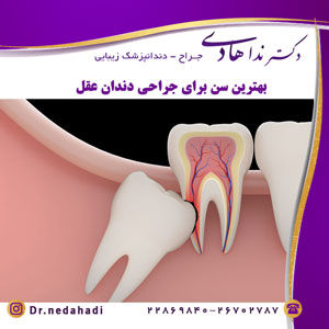 بهترین سن برای جراحی دندان عقل درد بعد از کشیدن دندان عقل پایین آیا دندان عقل را باید کشید