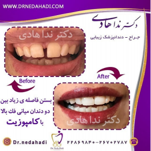 کامپوزیت دندان توسط دکتر ندا هادی