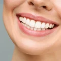 اصلاح طرح لبخند