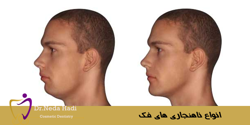 انواع ناهنجاری های فک