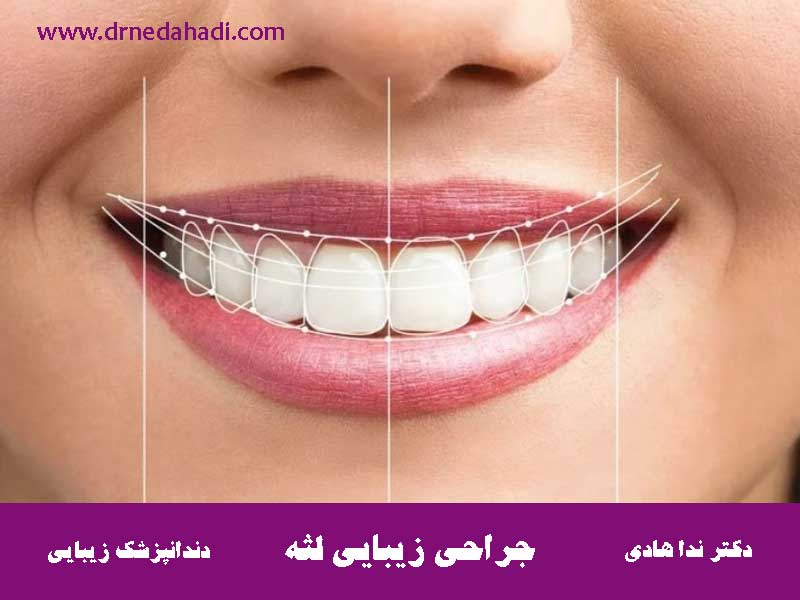 هزینه-جراحی-زیبایی-لثه