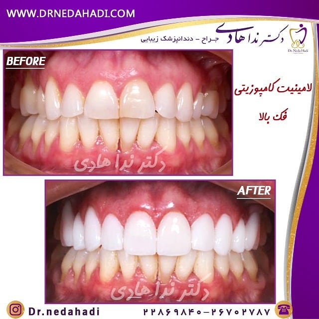 نمونه لمینت دندان دکتر ندا هادی