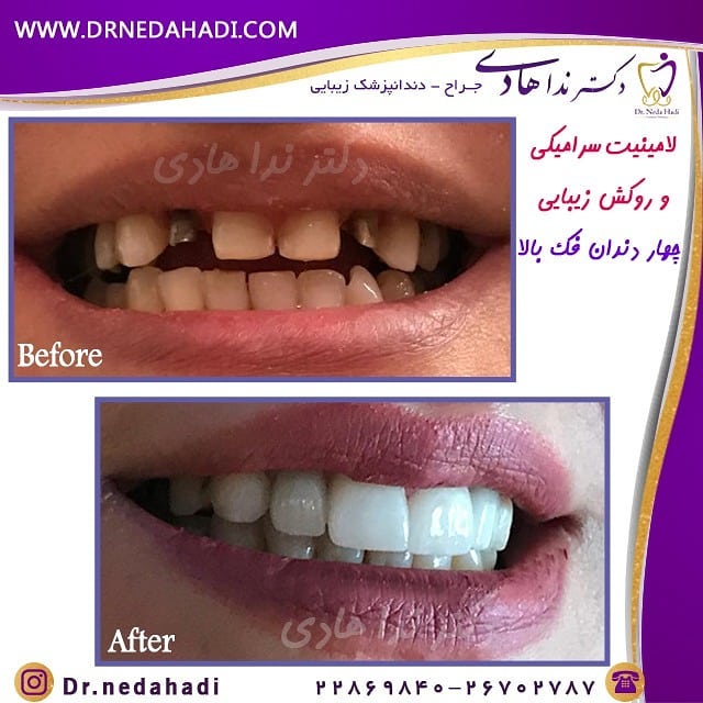 نمونه لمینت دندان دکتر ندا هادی