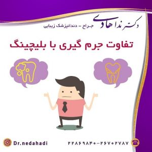 تفاوت جرمگیری و بلیچینگ دندان