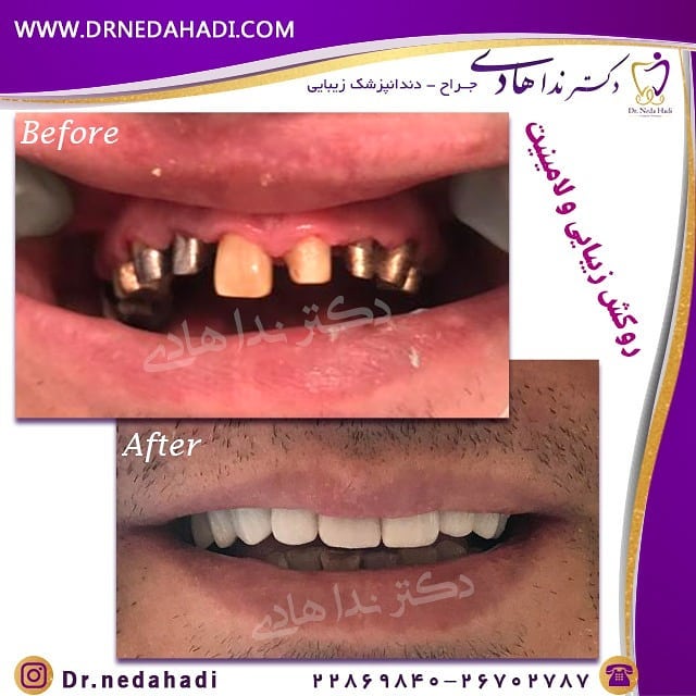 نمونه ایمپلنت فوری دندان توسط دکتر ندا هادی