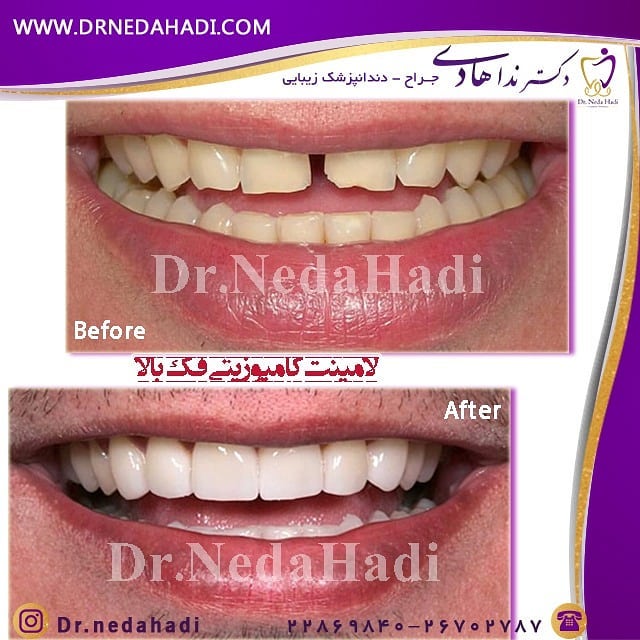نمونه لمینت دندان دکتر ندا هادی