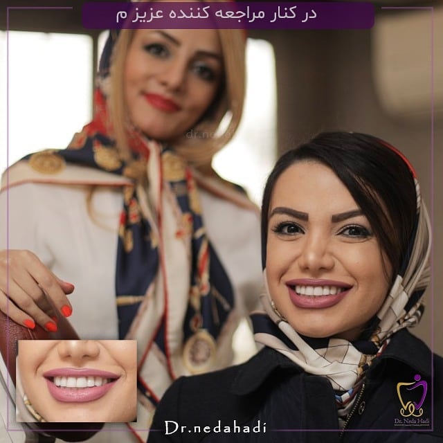 بهترین-دکتر-لمینت-دندان