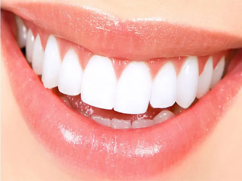 هزینه لمینت دندان چقدر است؟
