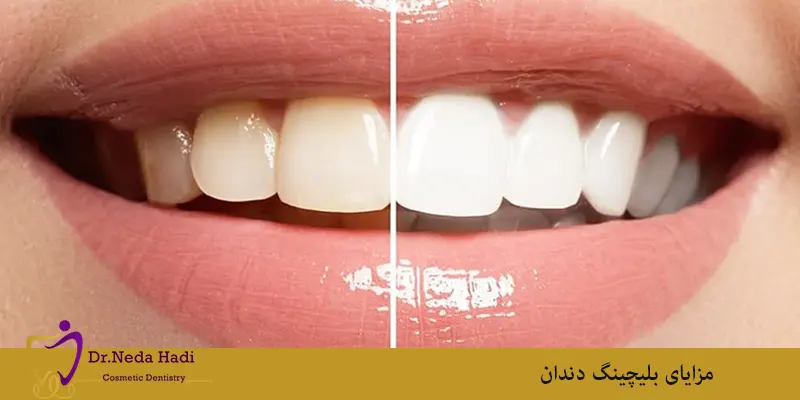 مزایای بلیچینگ دندان‌