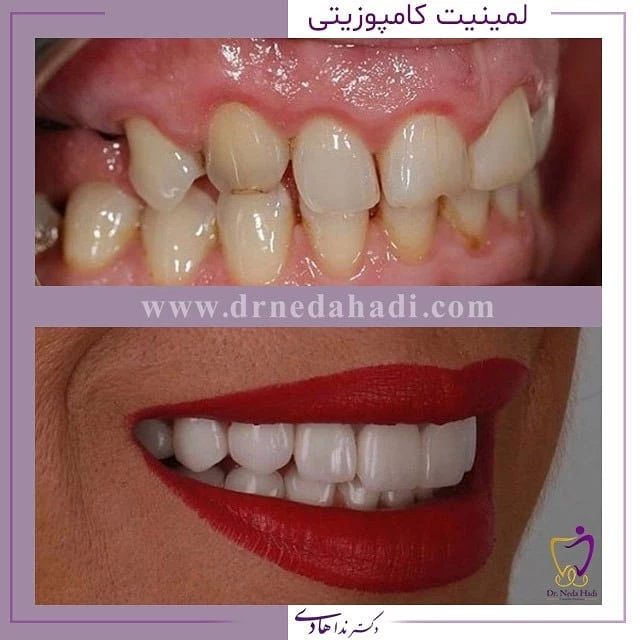 لمینت-کامپوزیتی
