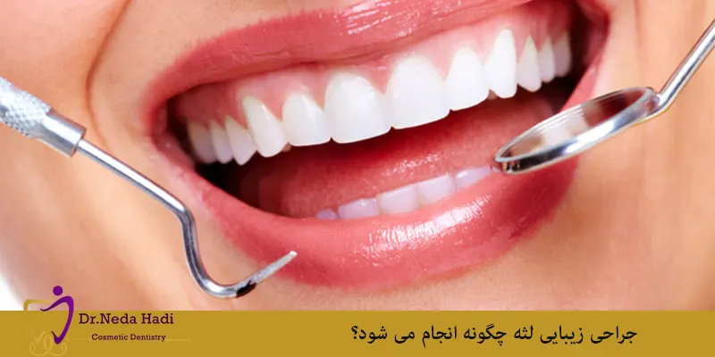جراحی زیبایی لثه چگونه انجام می شود؟