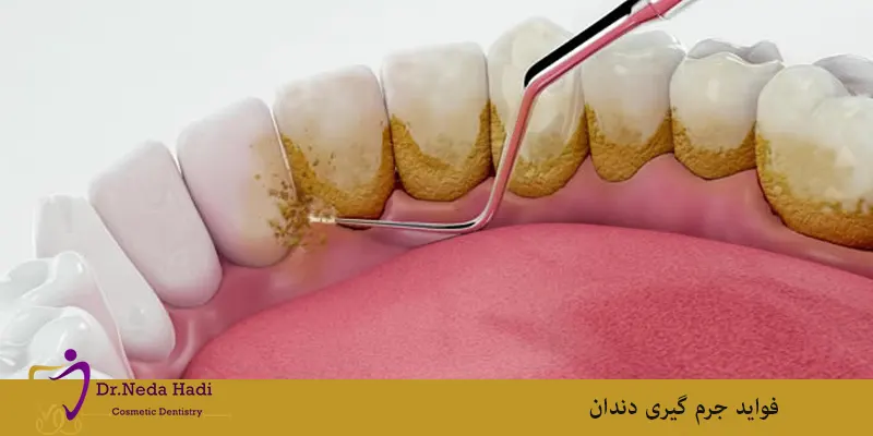 فواید جرم گیری دندان