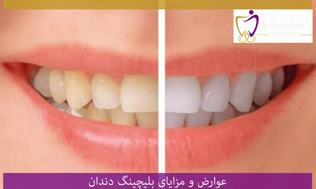 عوارض و مزایای بلیچینگ دندان