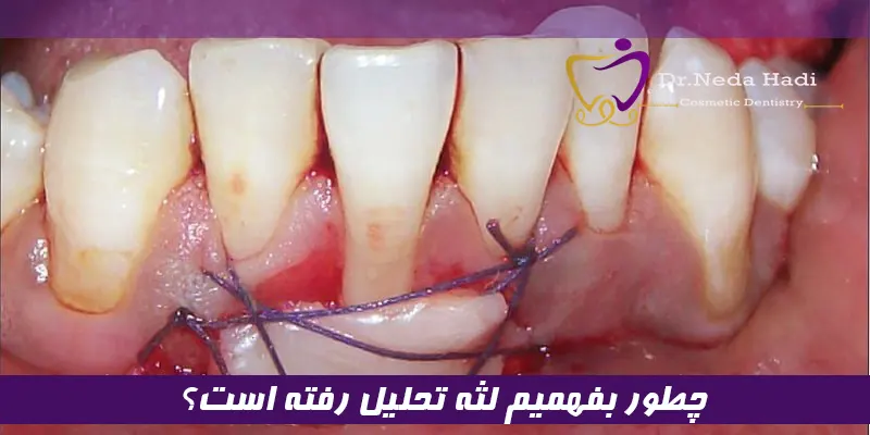 چطور بفهمیم لثه تحلیل رفته است؟