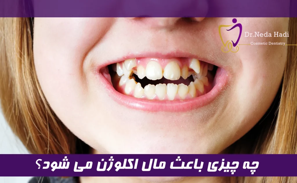  چه چیزی باعث مال اکلوژن می شود؟