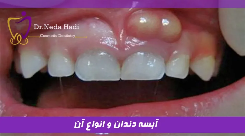 آبسه دندان و انواع آن
