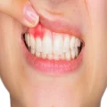 آبسه دندان چیست