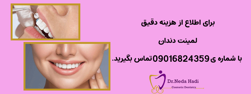 شماره-تماس-بابت-هزینه-لمینت-دندان
