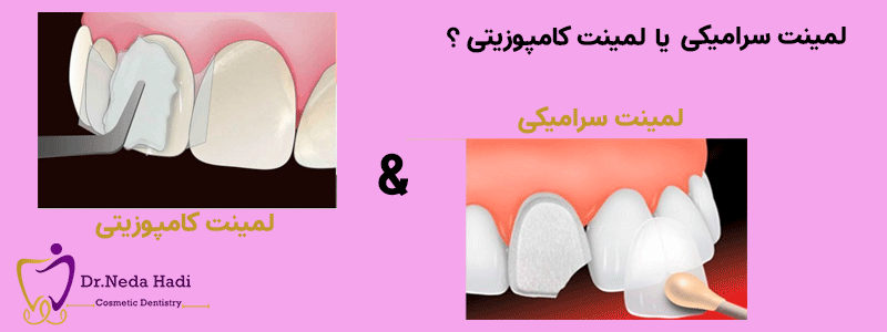لمینت-سرامیکی-یا-کامپوزیتی-لینک-به-مقاله