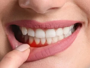 التهاب لثه بعد از کامپوزیت