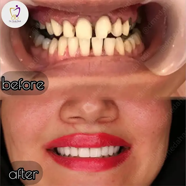 نمونه کار لمینت دندان