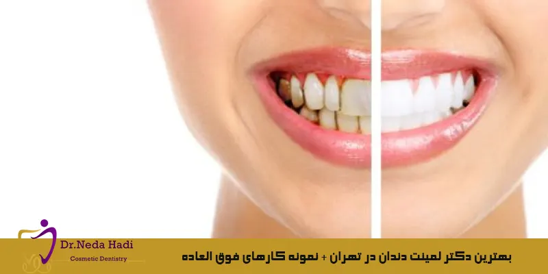 بهترین-دکتر-لمینت-دندان-در-تهران-نمونه-کارهای-فوق-العاده