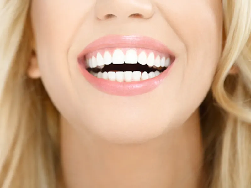 جراحی لثه برای کامپوزیت دندان
