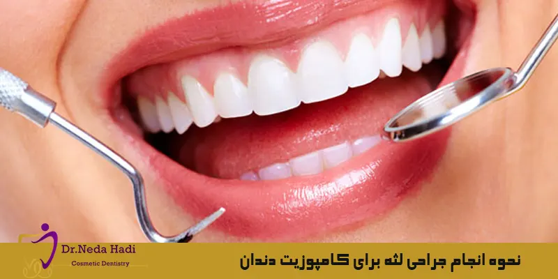 نحوه-انجام-جراحی-لثه-برای-کامپوزیت-دندان