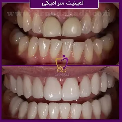 لمینت-سرامیکی