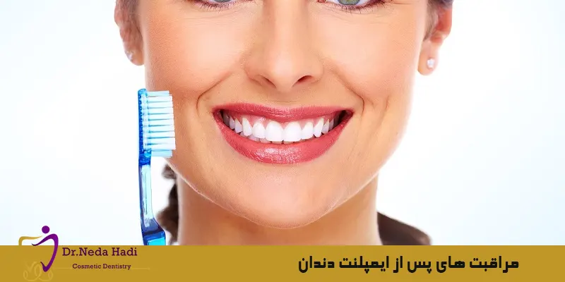 مراقبت-های-پس-از-ایمپلنت-دندان