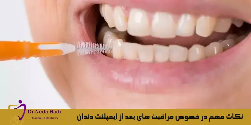 نکات-مهم-در-خصوص-مراقبت-های-بعد-از-ایمپلنت-دندان
