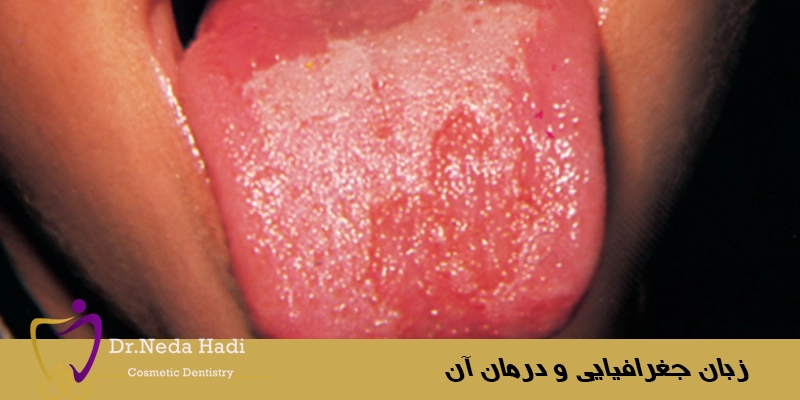 زبان-جغرافیایی-و-درمان-آن