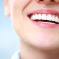 لمینت سرامیکی دندان
