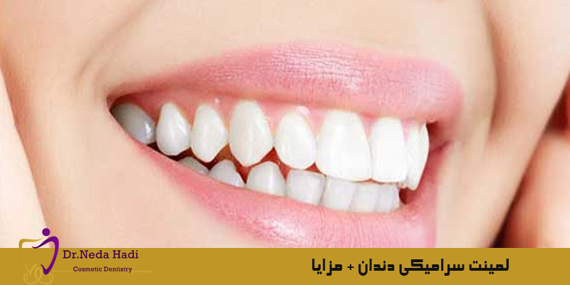 لمینت-سرامیکی-دندان-مزایا