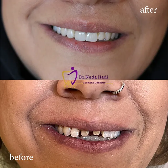کامپوزیت دندان 1