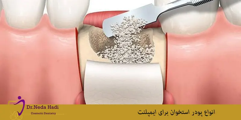 انواع-پودر-استخوان-برای-ایمپلنت