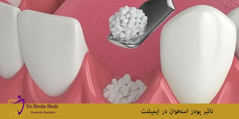 تاثیر-پودر-استخوان-در-ایمپلنت
