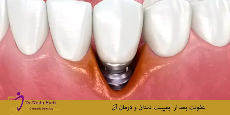 عفونت-بعد-از-ایمپبنت-دندان-و-درمان-آن