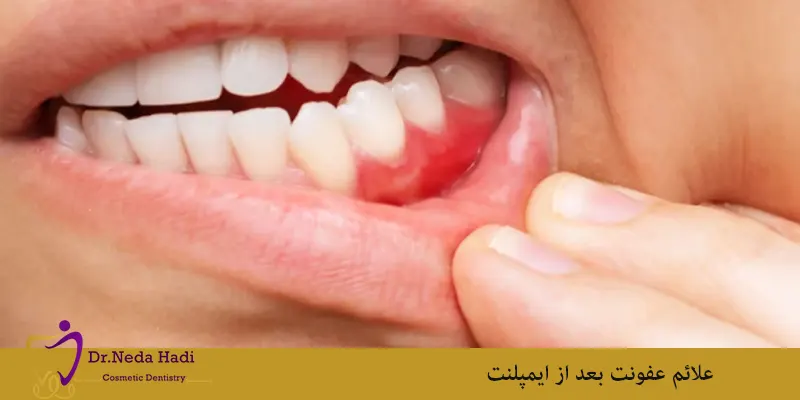 علائم-عفونت-بعد-از-ایمپلنت