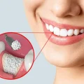 پودر استخوان برای ایمپلنت