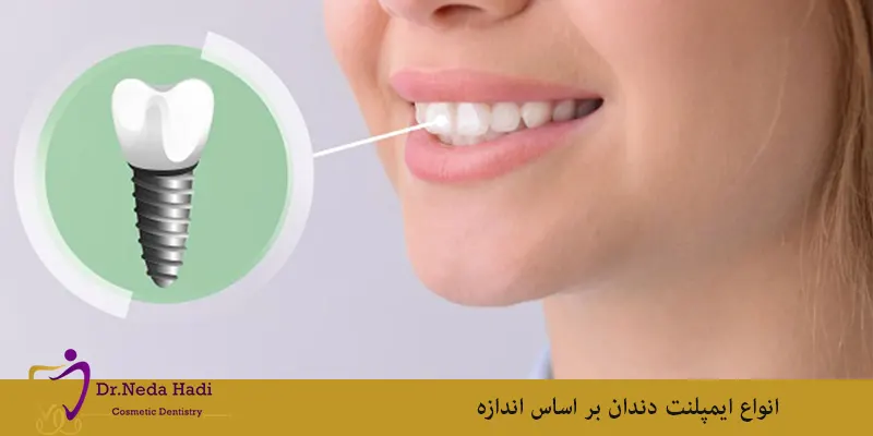 انواع-ایمپلنت-دندان-بر-اساس-اندازه