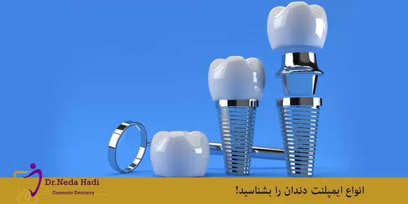 انواع-ایمپلنت-دندان-را-بشناسید