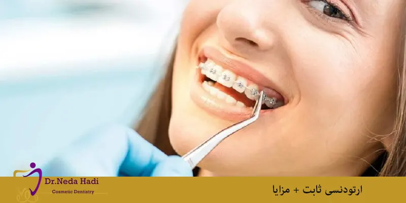 ارتودنسی ثابت + مزایا