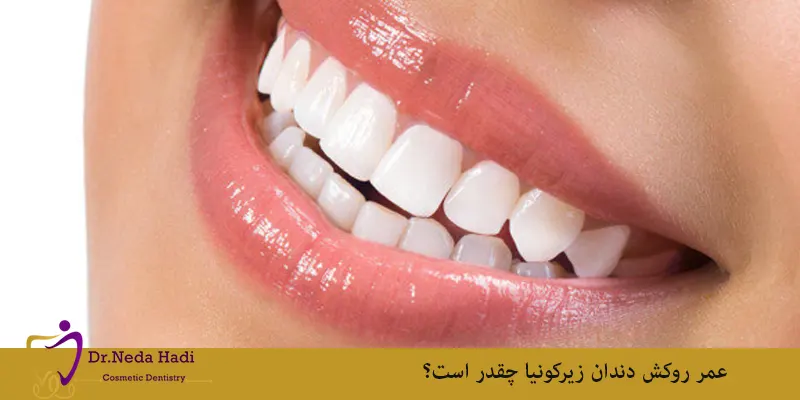 عمر روکش دندان زیرکونیا چقدر است؟