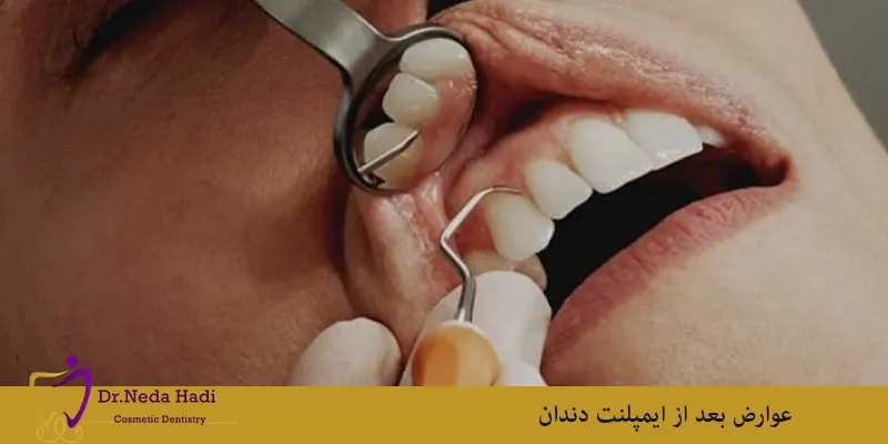 عوارض بعد از ایمپلنت دندان