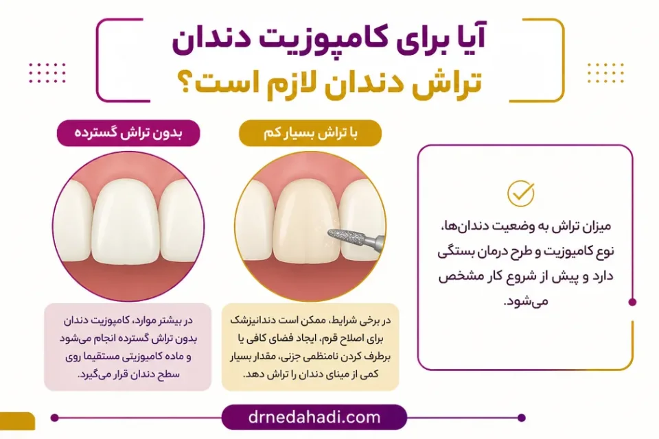 نمای توضیحی درباره آیا برای کامپوزیت دندان تراش دندان لازم است